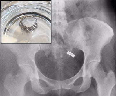 Jet-Lagged Woman Accidentally Swallows Wedding Ring With Handful of Vitamins